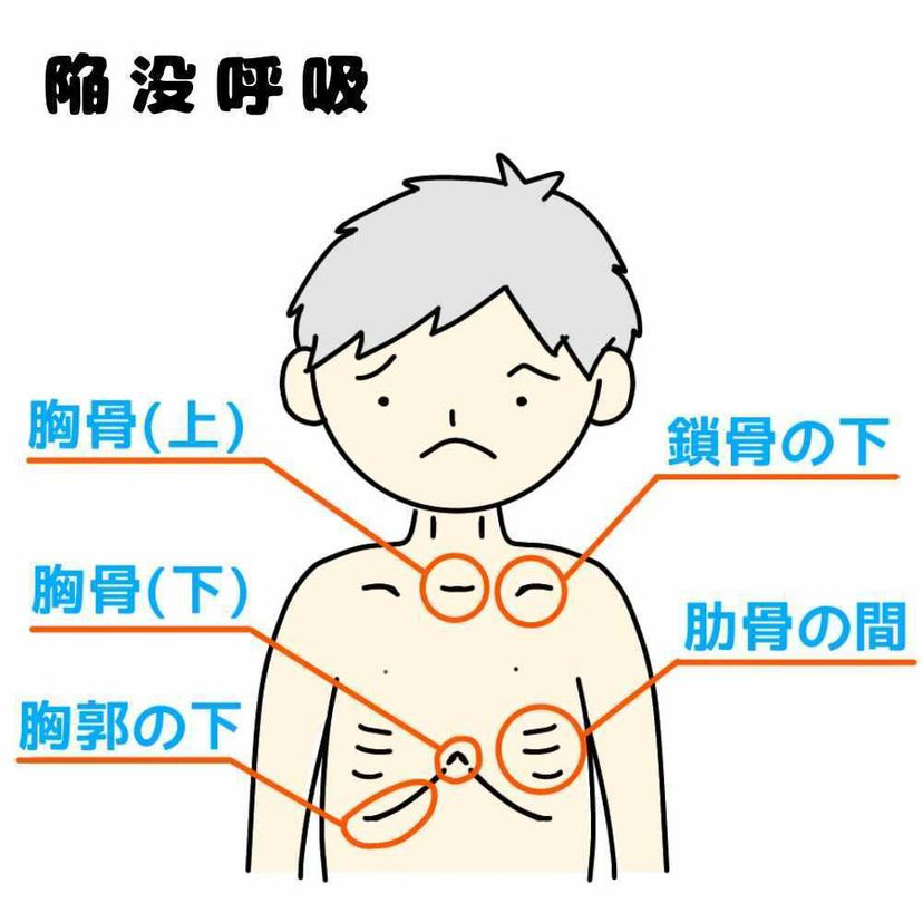 これって陥没呼吸 新生児のお腹のペコペコが気になる方へ 症状とリハビリ 医療的ケア児と家族を支える アンリーシュ